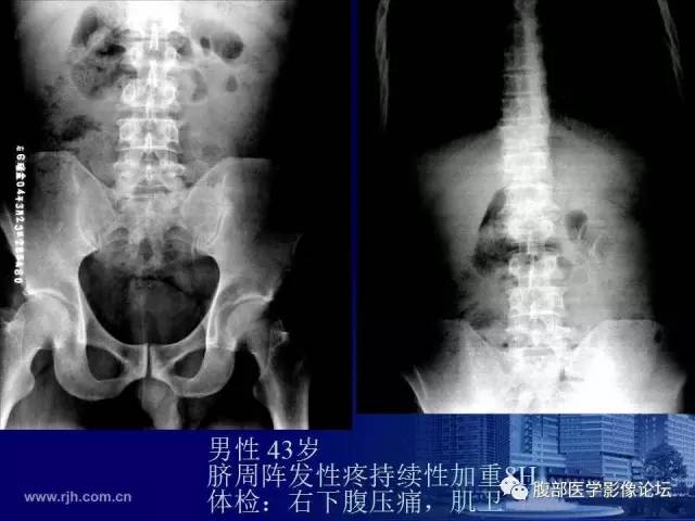 【PPT】急性绞窄性肠梗阻CT诊断