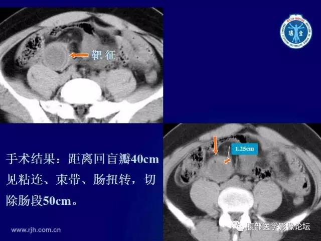 【PPT】急性绞窄性肠梗阻CT诊断