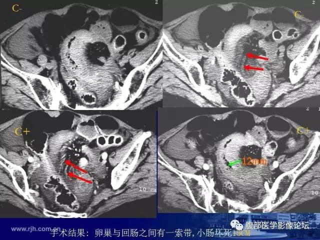 【PPT】急性绞窄性肠梗阻CT诊断