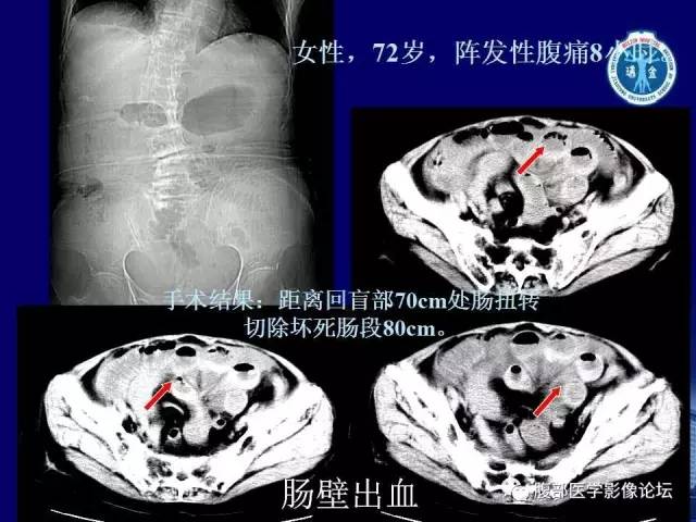 【PPT】急性绞窄性肠梗阻CT诊断