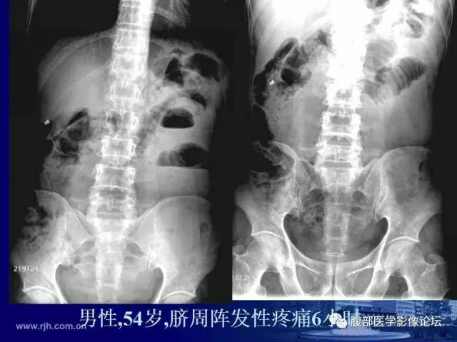 【PPT】急性绞窄性肠梗阻CT诊断