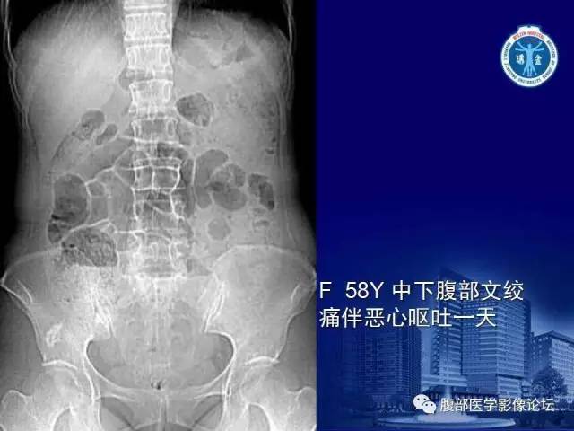 【PPT】急性绞窄性肠梗阻CT诊断