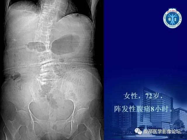 【PPT】急性绞窄性肠梗阻CT诊断