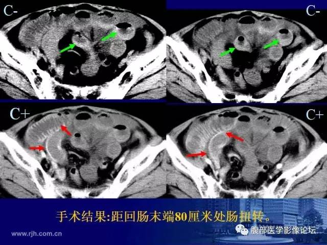 【PPT】急性绞窄性肠梗阻CT诊断