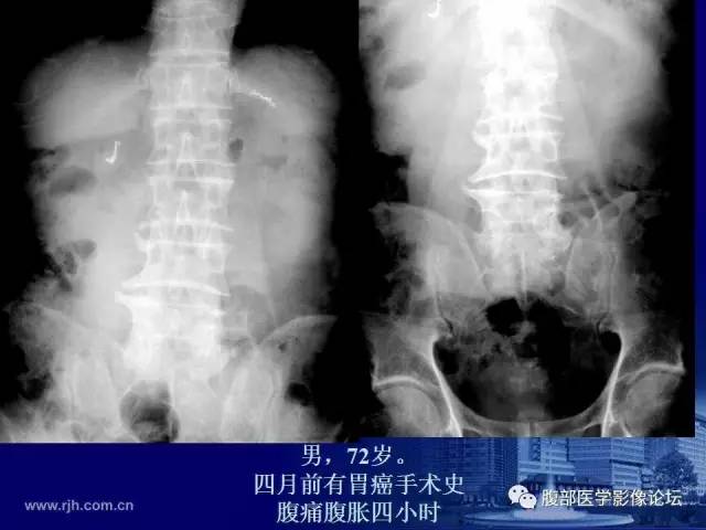 【PPT】急性绞窄性肠梗阻CT诊断