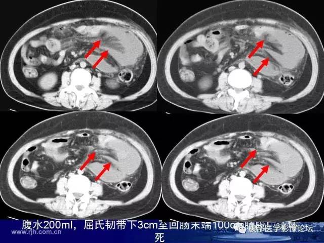 【PPT】急性绞窄性肠梗阻CT诊断
