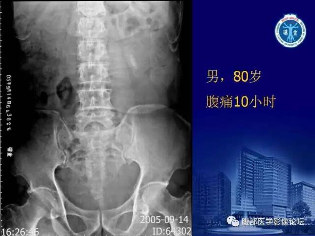 【PPT】急性绞窄性肠梗阻CT诊断