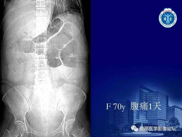 【PPT】急性绞窄性肠梗阻CT诊断