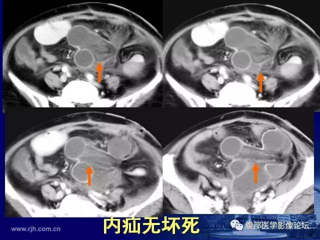 【PPT】急性绞窄性肠梗阻CT诊断