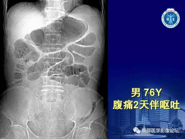 【PPT】急性绞窄性肠梗阻CT诊断