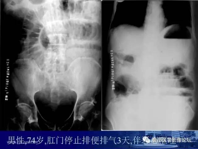 【PPT】急性绞窄性肠梗阻CT诊断