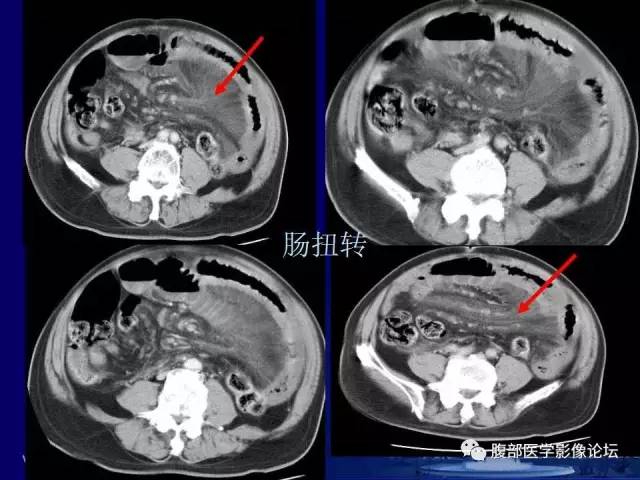 【PPT】急性绞窄性肠梗阻CT诊断