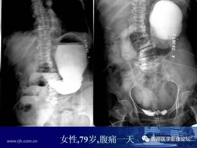 【PPT】急性绞窄性肠梗阻CT诊断