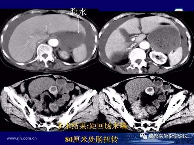 【PPT】急性绞窄性肠梗阻CT诊断
