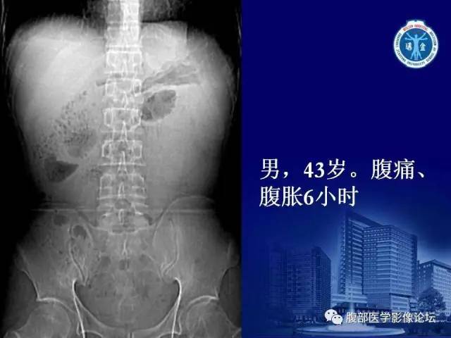 【PPT】急性绞窄性肠梗阻CT诊断