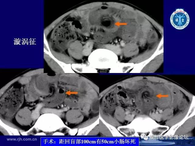 【PPT】急性绞窄性肠梗阻CT诊断