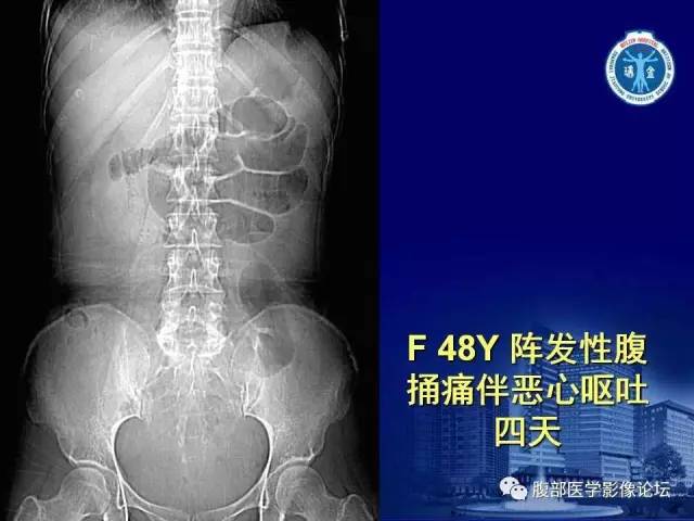 【PPT】急性绞窄性肠梗阻CT诊断