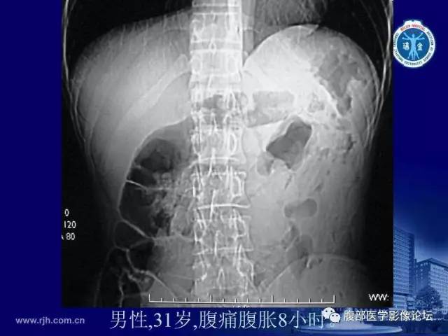 【PPT】急性绞窄性肠梗阻CT诊断