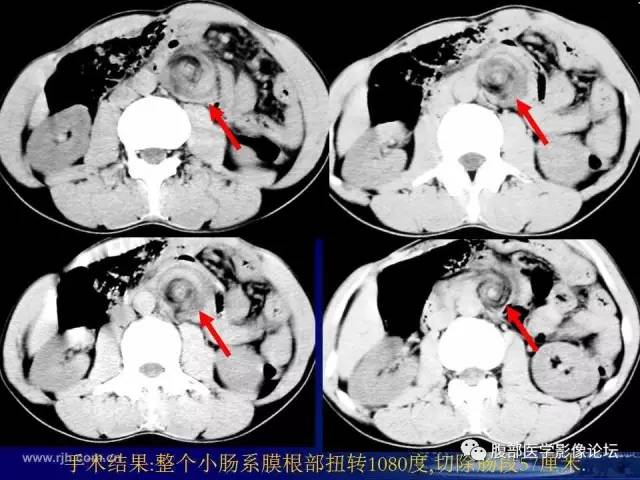 【PPT】急性绞窄性肠梗阻CT诊断