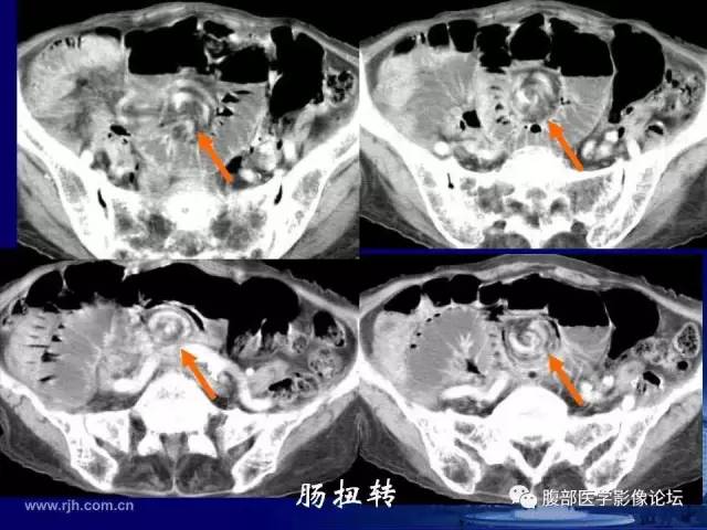 【PPT】急性绞窄性肠梗阻CT诊断