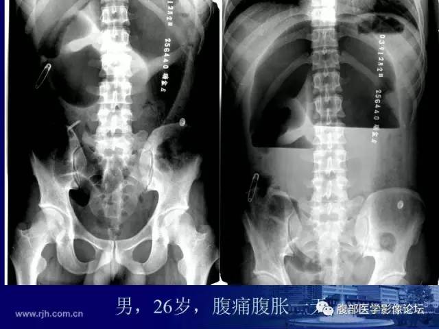 【PPT】急性绞窄性肠梗阻CT诊断