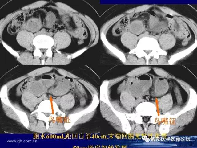 【PPT】急性绞窄性肠梗阻CT诊断