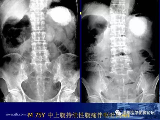 【PPT】急性绞窄性肠梗阻CT诊断