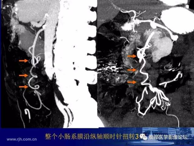 【PPT】急性绞窄性肠梗阻CT诊断