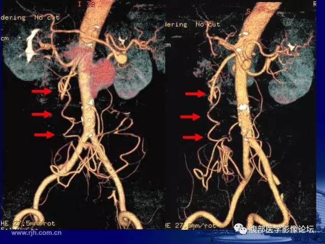 【PPT】急性绞窄性肠梗阻CT诊断