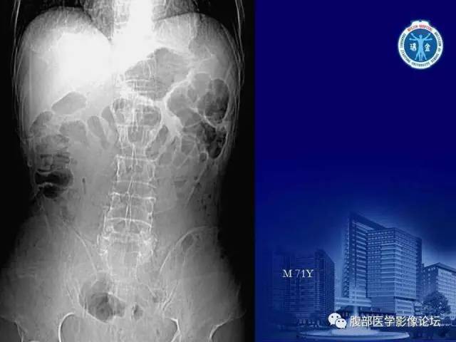 【PPT】急性绞窄性肠梗阻CT诊断