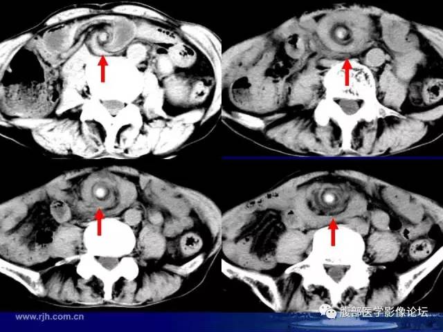 【PPT】急性绞窄性肠梗阻CT诊断