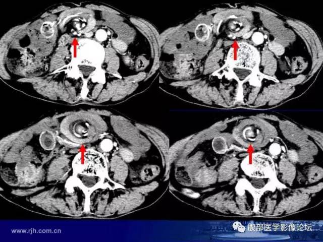 【PPT】急性绞窄性肠梗阻CT诊断