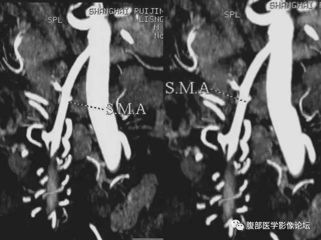 【PPT】急性绞窄性肠梗阻CT诊断