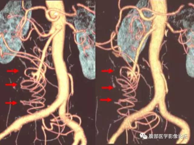 【PPT】急性绞窄性肠梗阻CT诊断