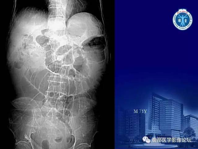 【PPT】急性绞窄性肠梗阻CT诊断