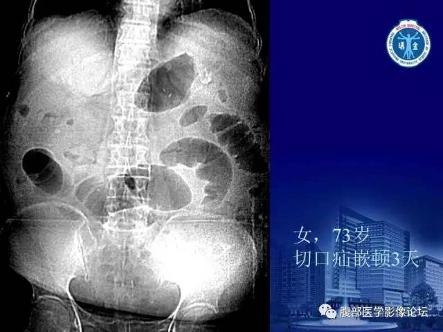 【PPT】急性绞窄性肠梗阻CT诊断
