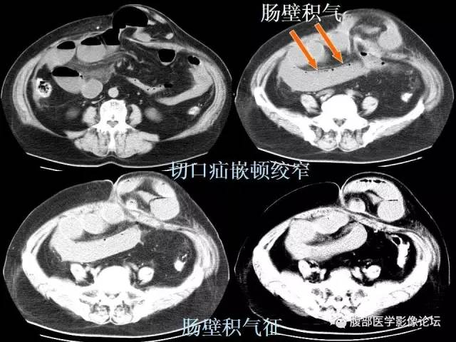 【PPT】急性绞窄性肠梗阻CT诊断
