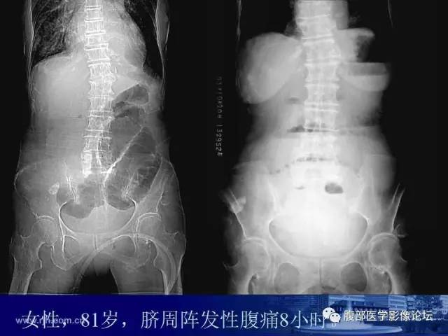 【PPT】急性绞窄性肠梗阻CT诊断