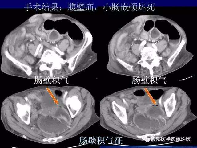 【PPT】急性绞窄性肠梗阻CT诊断