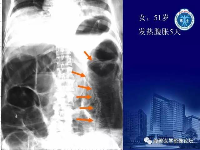 【PPT】急性绞窄性肠梗阻CT诊断