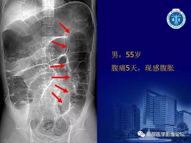 【PPT】急性绞窄性肠梗阻CT诊断