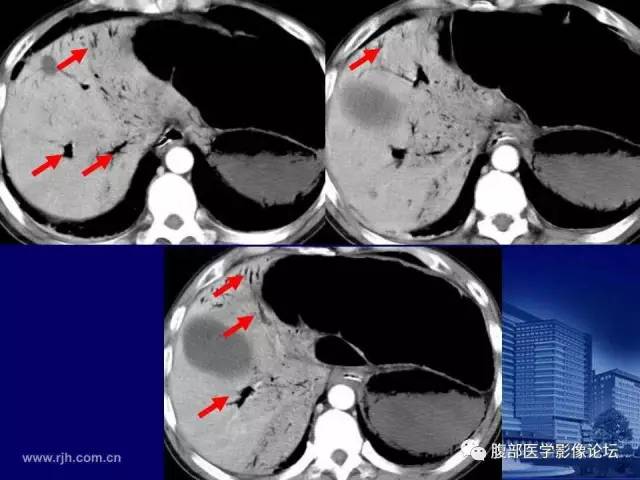 【PPT】急性绞窄性肠梗阻CT诊断