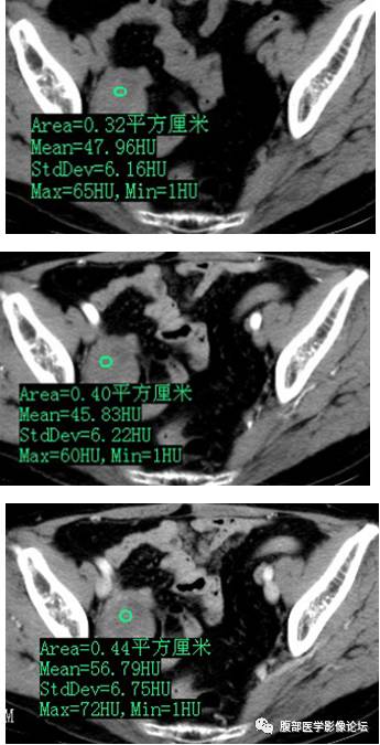 【病例】右侧卵巢甲状腺肿伴囊性变1例CT 【病例】右侧卵巢甲状腺肿伴囊性变1例CT