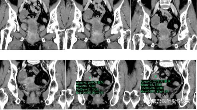 【病例】右侧卵巢甲状腺肿伴囊性变1例CT 【病例】右侧卵巢甲状腺肿伴囊性变1例CT