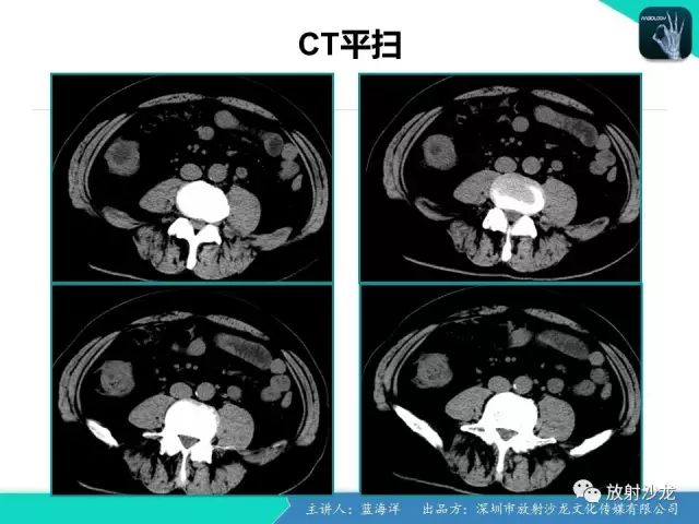 【病例】肠囊肿型重复畸形1例CT
