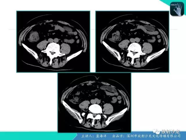 【病例】肠囊肿型重复畸形1例CT