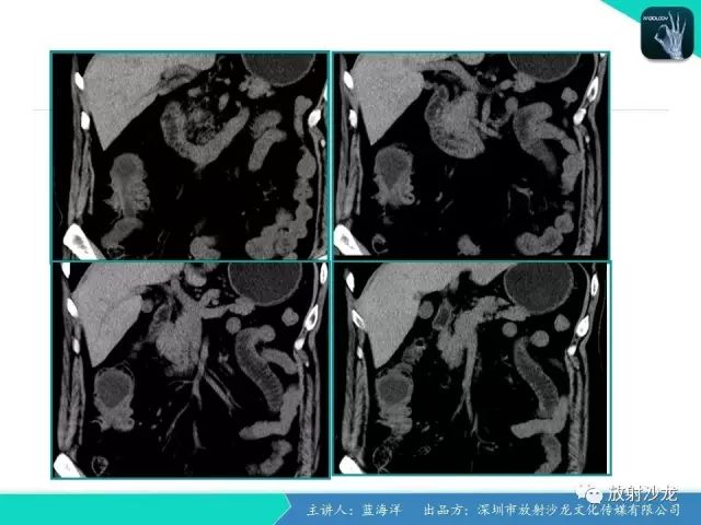 【病例】肠囊肿型重复畸形1例CT