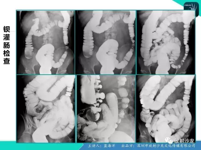 【病例】肠囊肿型重复畸形1例CT