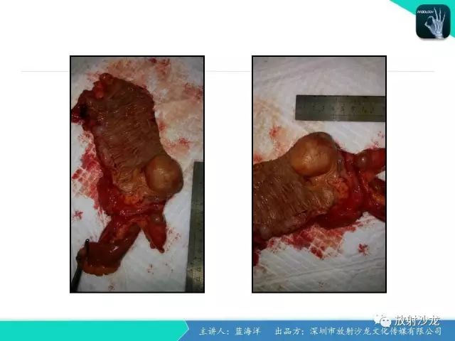 【病例】肠囊肿型重复畸形1例CT
