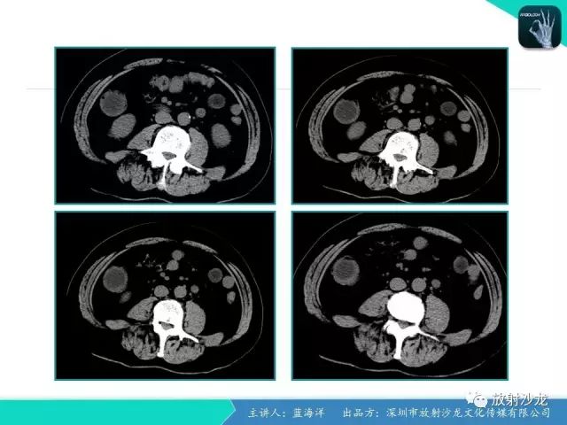 【病例】肠囊肿型重复畸形1例CT